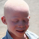 Imagen para el artículo titulado Decapitan a una niña de cinco años por sus presuntas propiedades mágicas: el terror de ser albino en algunos países de África